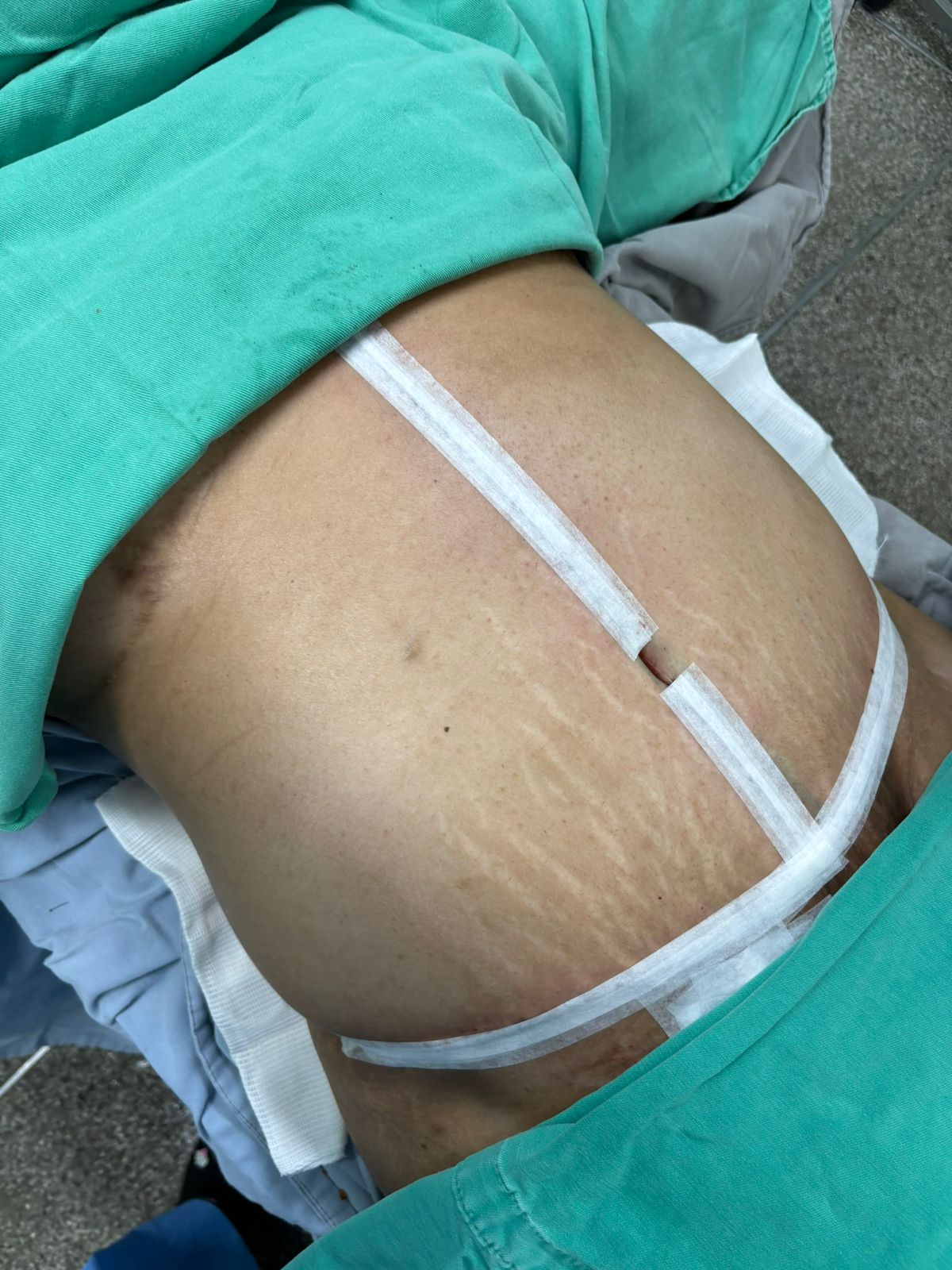 Resultado após cirurgia - Caso 2